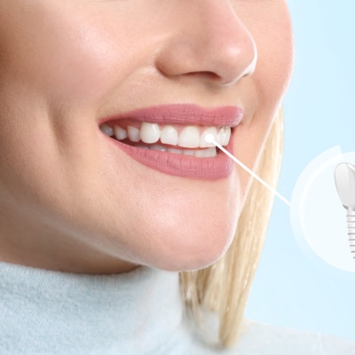 Dental Implants